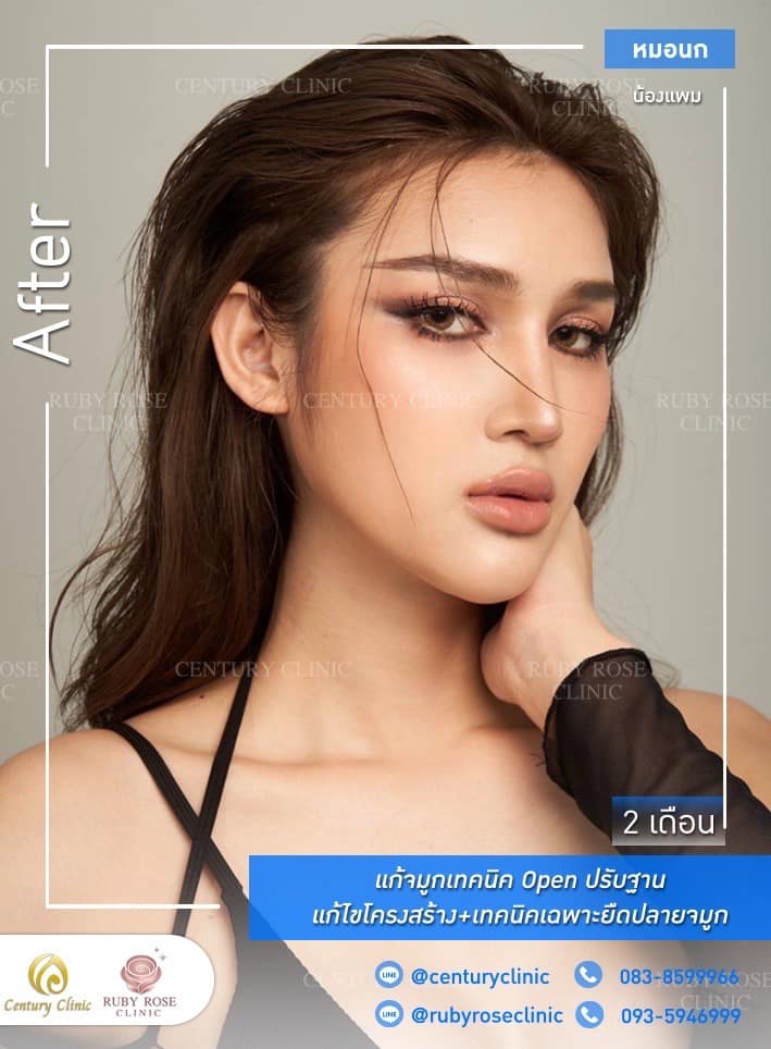 Century รีวิว แก้จมูก 1#276