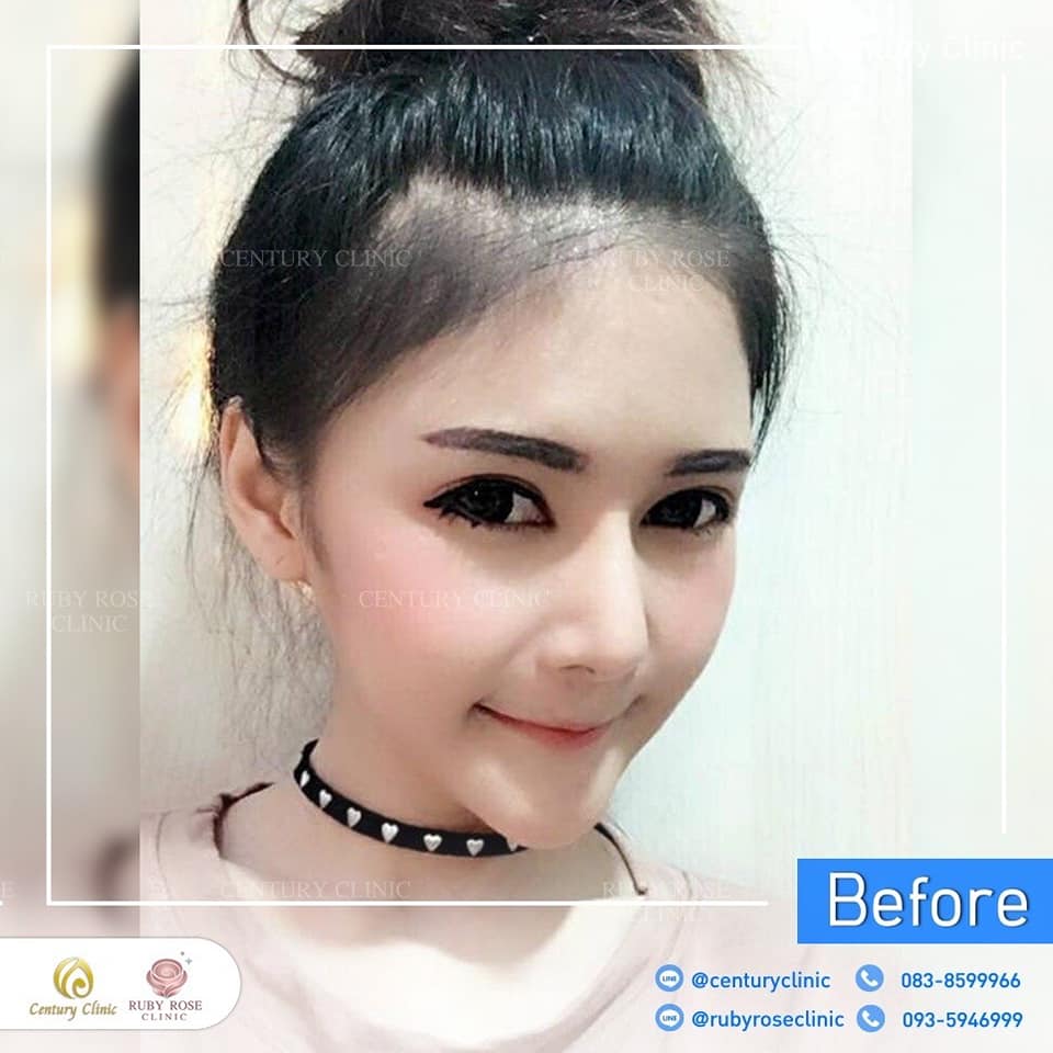 รีวิว แก้จมูก #277 , Century Clinic Thailand Century รีวิว แก้จมูก 1#277