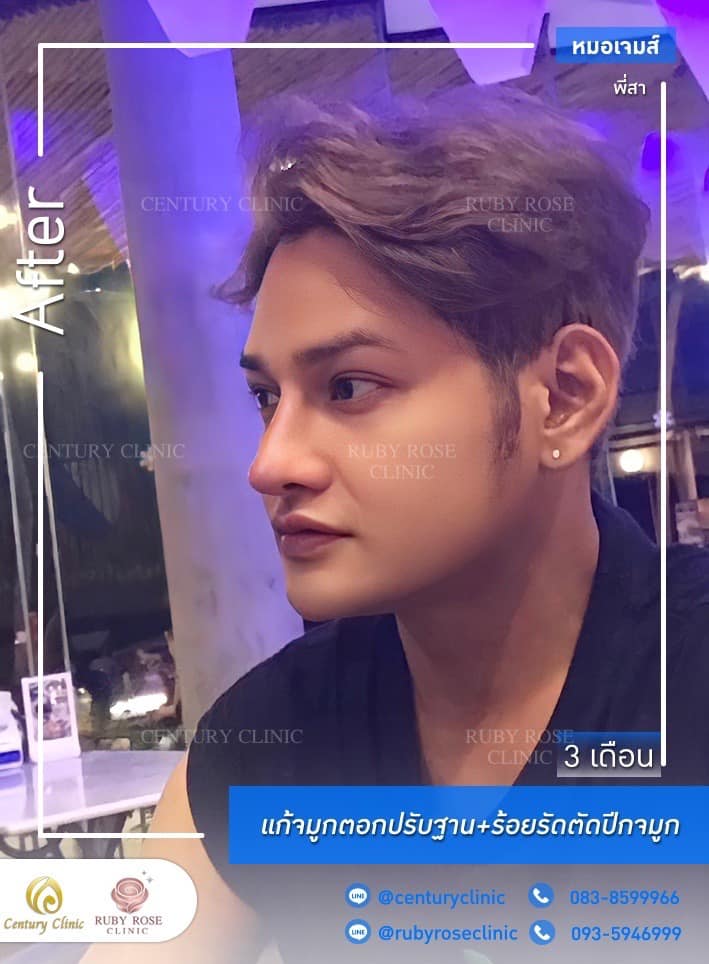 Century รีวิว แก้จมูก 2#278