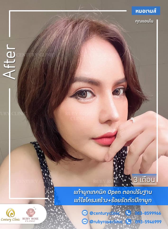 Century รีวิว แก้จมูก 1#283