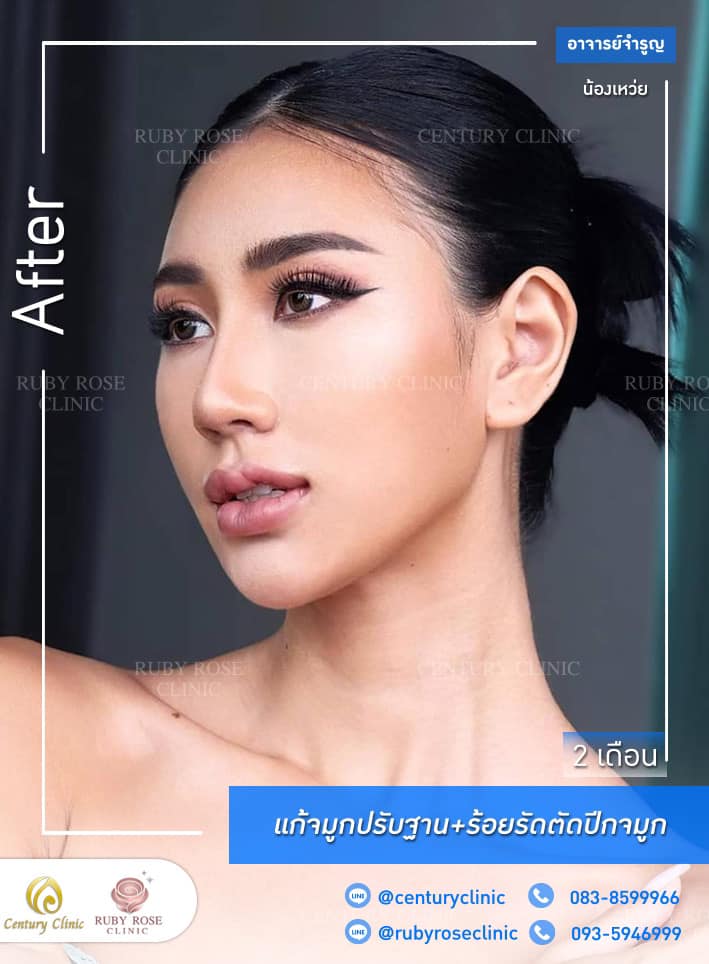 รีวิว แก้จมูก #284 , Century Clinic Thailand Century รีวิว แก้จมูก 1#284