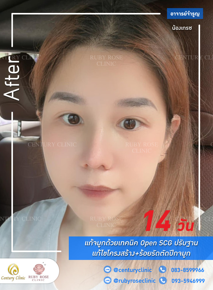 Century รีวิว แก้จมูก 1#286