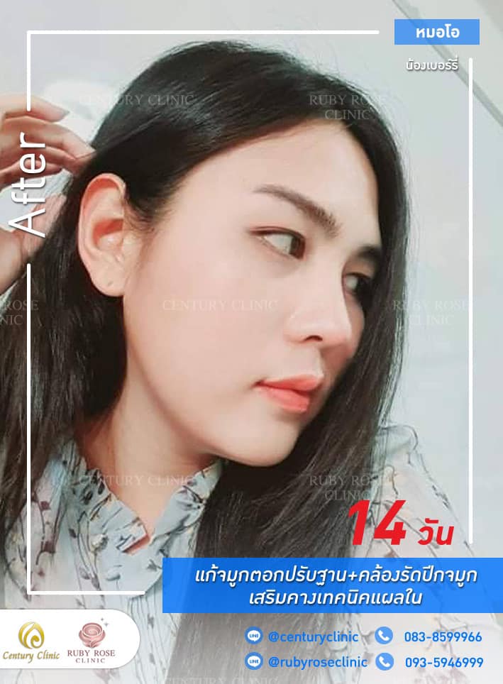 Century-รีวิว-แก้จมูก 1#291