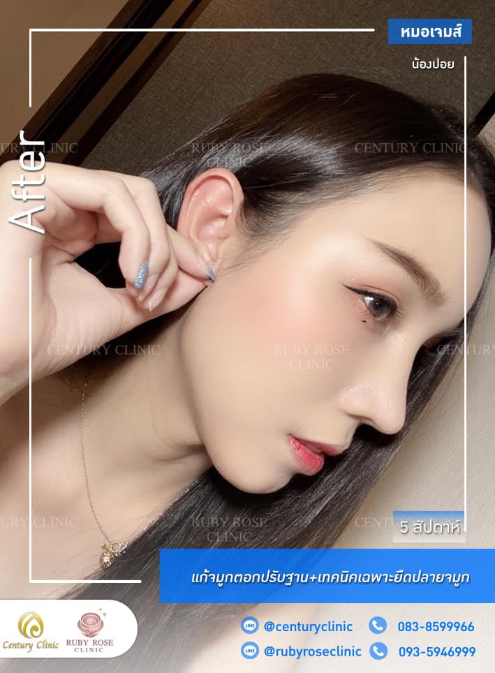 รีวิว แก้จมูก #292 , Century Clinic Thailand Century-รีวิว-แก้จมูก 1#292