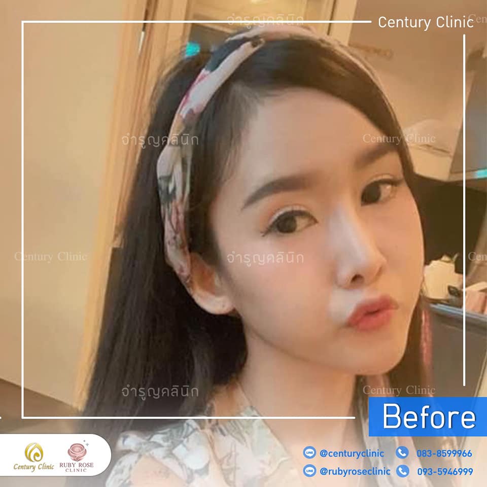 Century-รีวิว-แก้จมูก 1#293