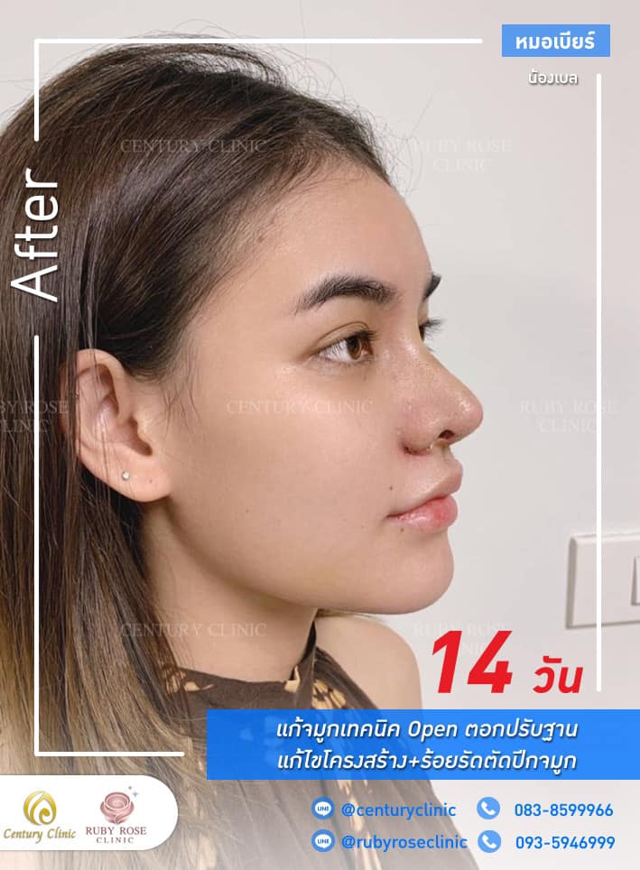 รีวิว แก้จมูก #294 , Century Clinic Thailand Century-รีวิว-แก้จมูก 1#294