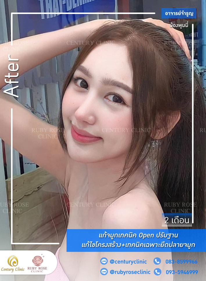 รีวิว แก้จมูก #297 , Century Clinic Thailand Century-รีวิว-แก้จมูก 1#297