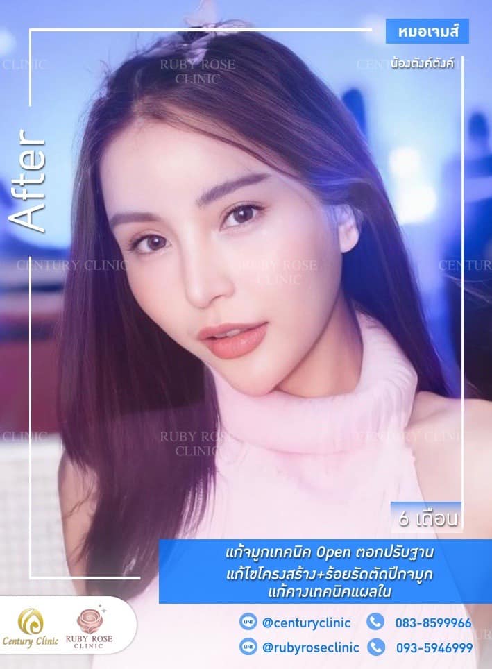 รีวิว แก้จมูก #298 , Century Clinic Thailand Century-รีวิว-แก้จมูก 1#298