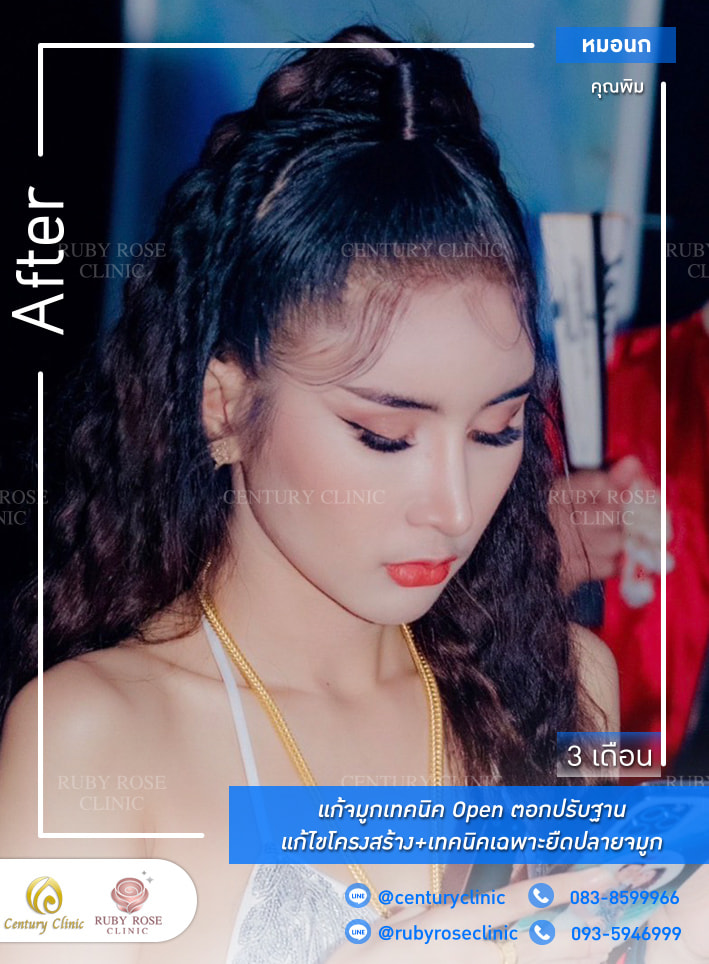 รีวิว แก้จมูก #303 , Century Clinic Thailand Century-รีวิว-แก้จมูก 1#303