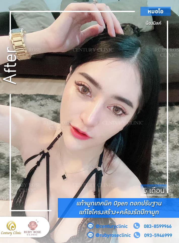 Century-รีวิว-แก้จมูก 1#304