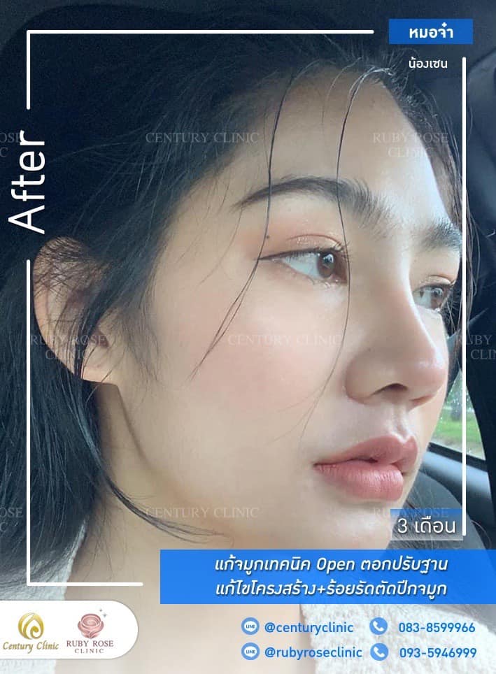 Century-รีวิว-แก้จมูก 2#308