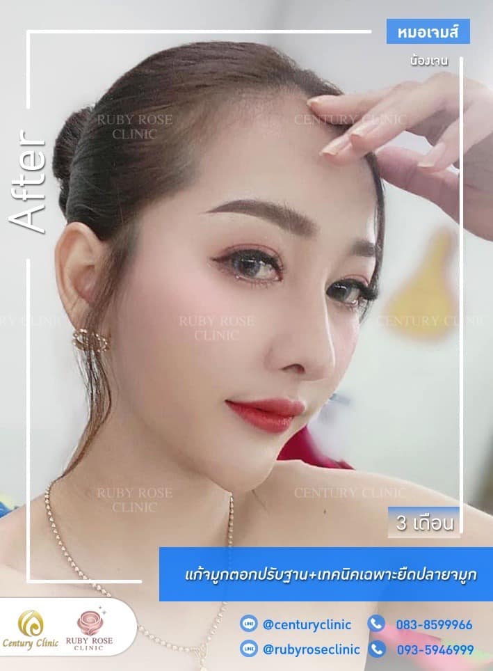 Century-รีวิว-แก้จมูก 1#309