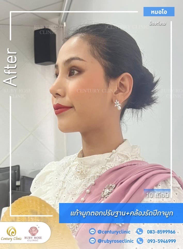 รีวิว แก้จมูก #311 , Century Clinic Thailand Century-รีวิว-แก้จมูก 1#311