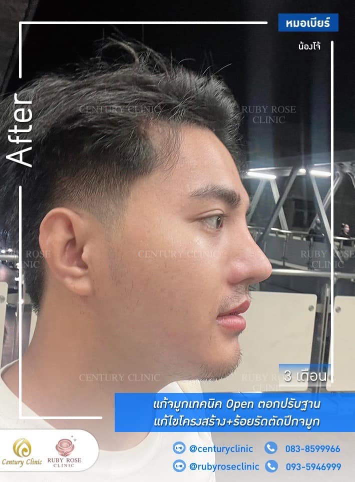 Century-รีวิว-แก้จมูก 1#313