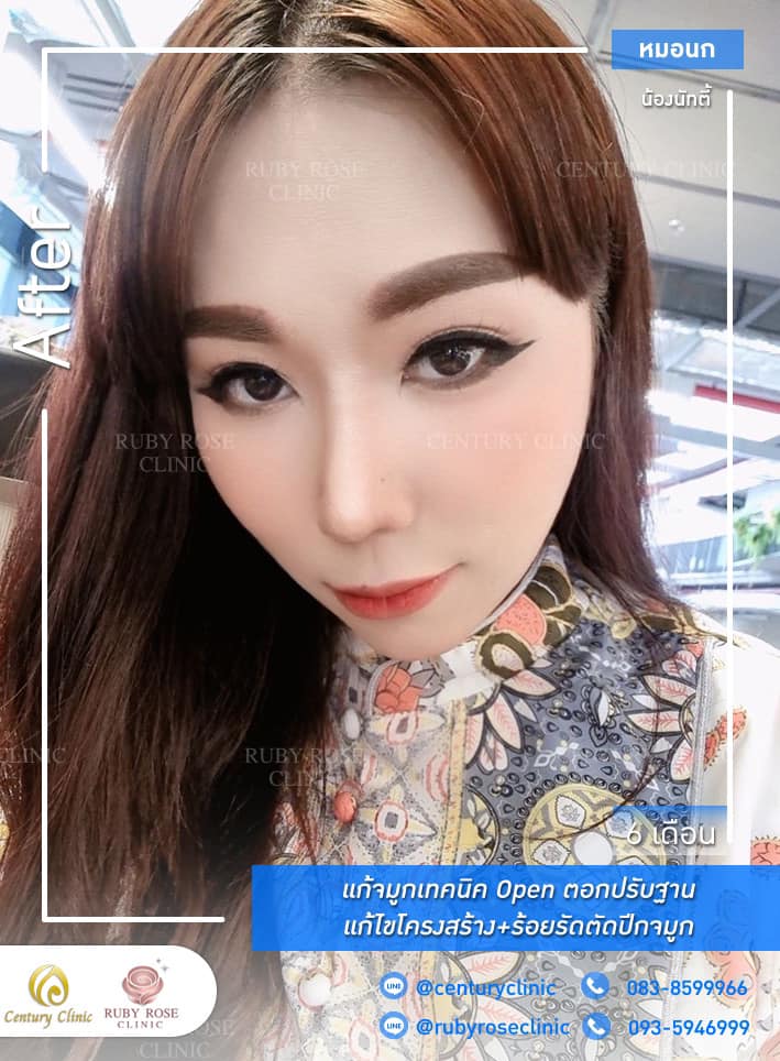 รีวิว แก้จมูก #316 , Century Clinic Thailand Century-รีวิว-แก้จมูก 1#316
