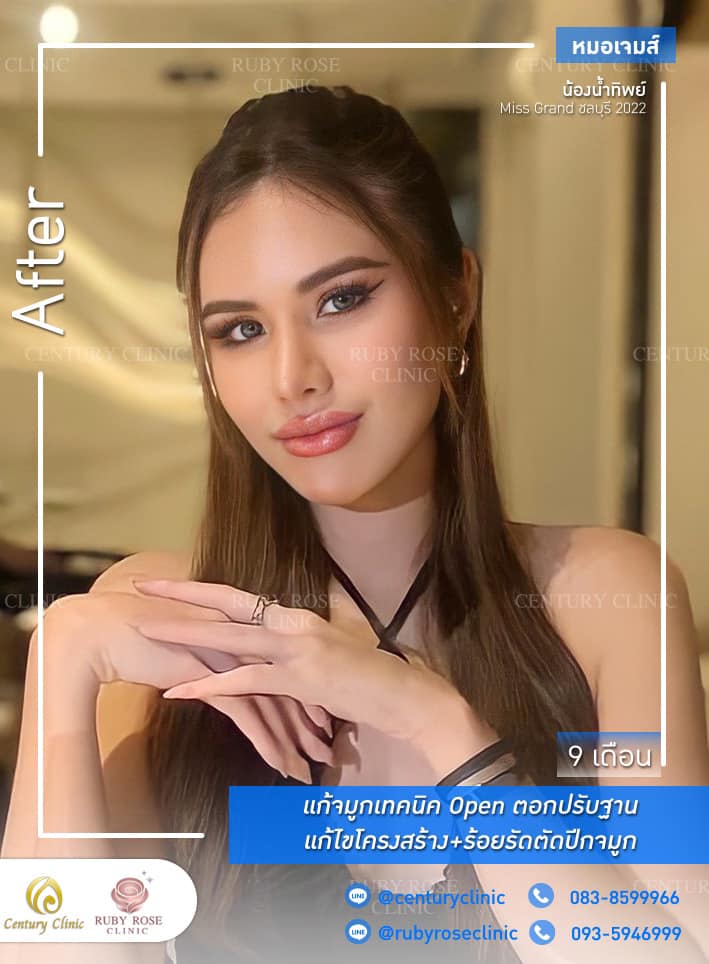 Century-รีวิว-แก้จมูก 1#317