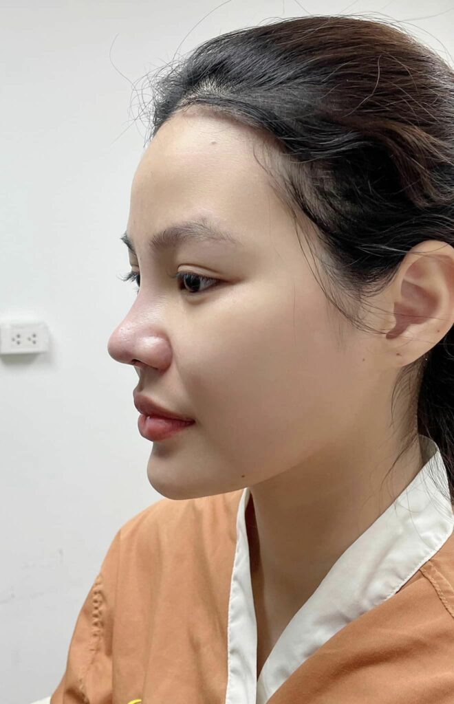 รีวิว แก้จมูก #318 , Century Clinic Thailand Century-รีวิว-แก้จมูก 1#318