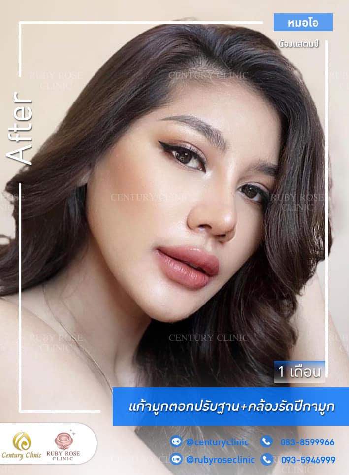 Century-รีวิว-แก้จมูก 1#324