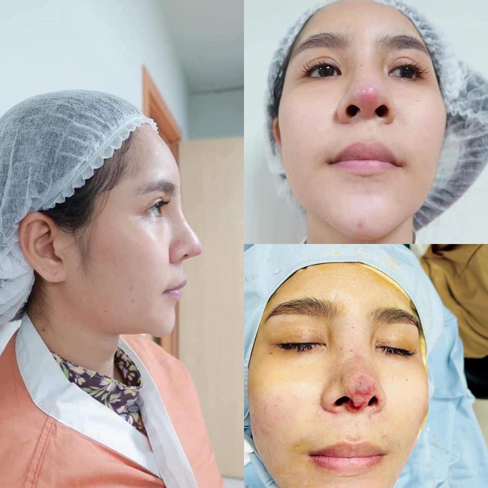 รีวิว แก้จมูก #328 , Century Clinic Thailand Century-รีวิว-แก้จมูก 1#328