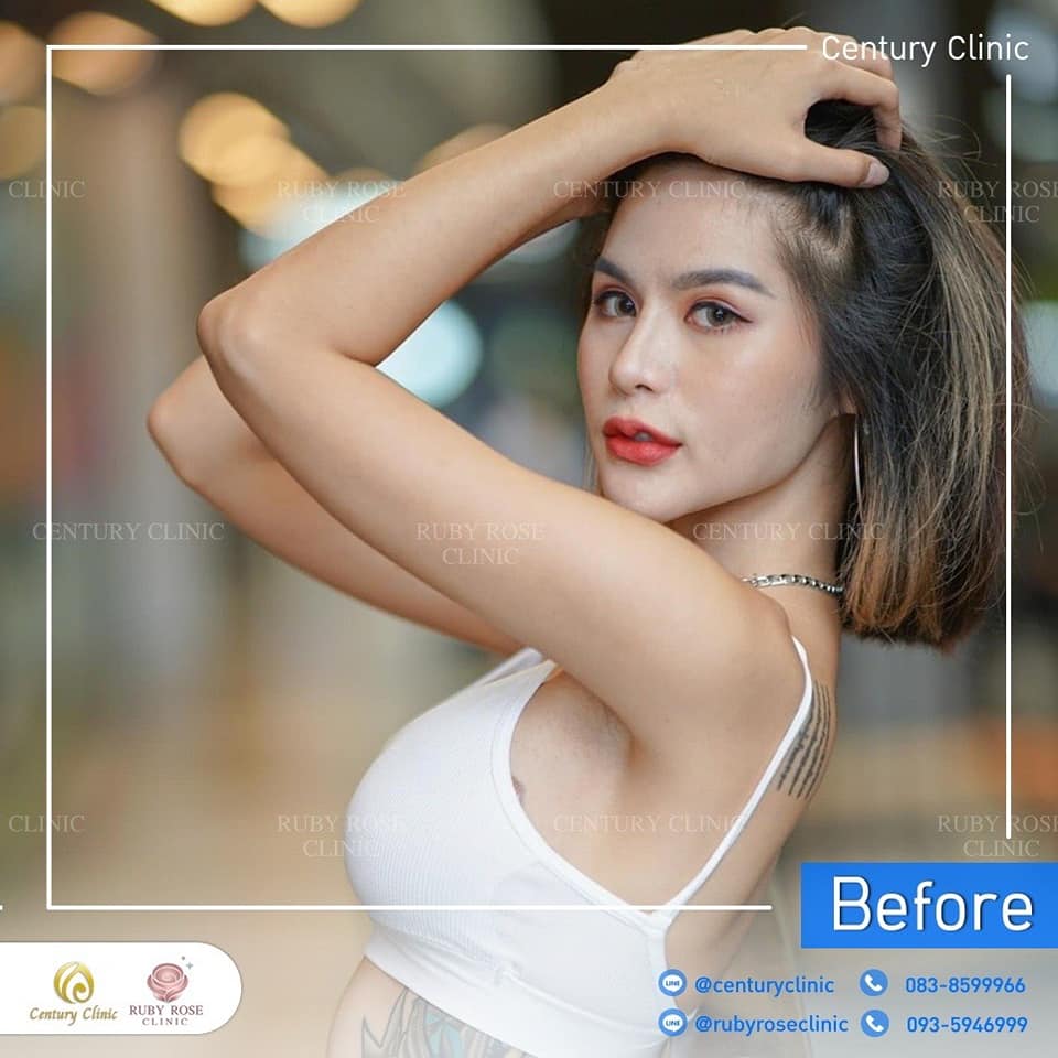 รีวิว แก้จมูก #332 , Century Clinic Thailand Century-รีวิว-แก้จมูก 1#332