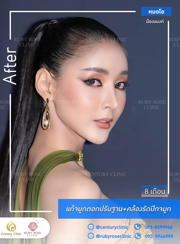 รีวิว แก้จมูก #333 , Century Clinic Thailand Century-รีวิว-แก้จมูก 1#333