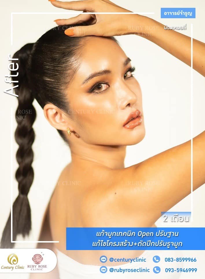 Century-รีวิว-แก้จมูก 1#335
