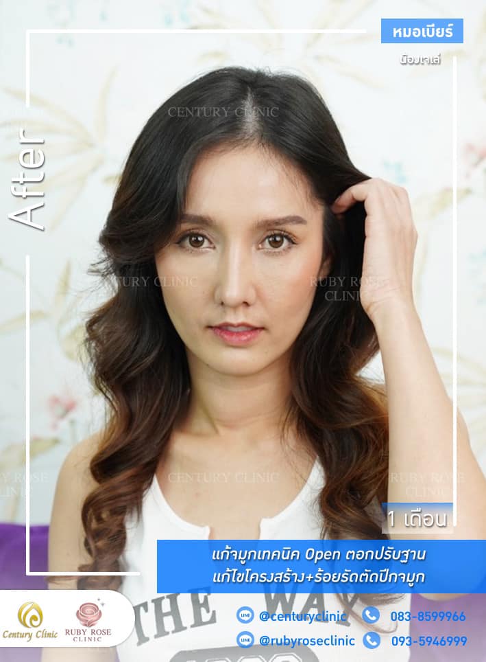 รีวิว แก้จมูก #336 , Century Clinic Thailand Century-รีวิว-แก้จมูก 1#336