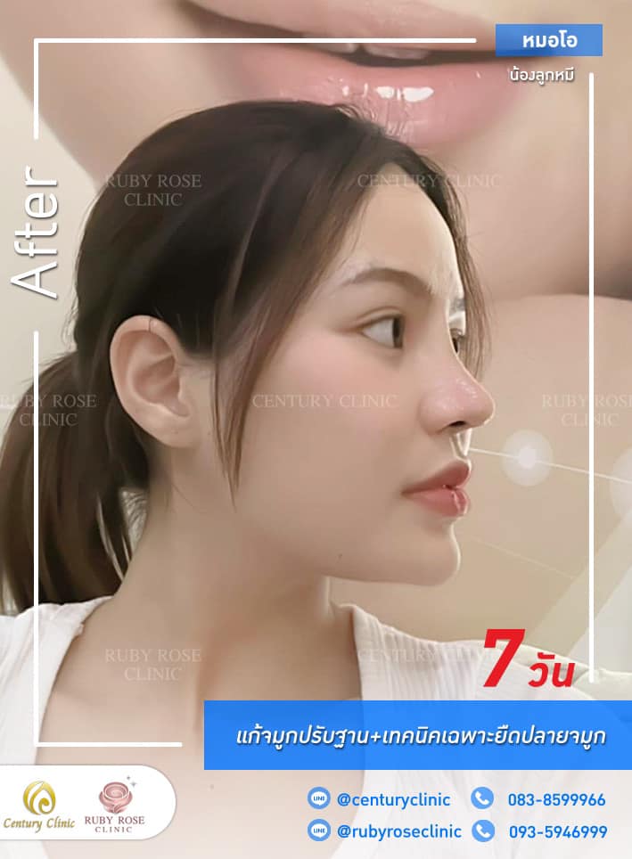 Century-รีวิว-แก้จมูก 1#338