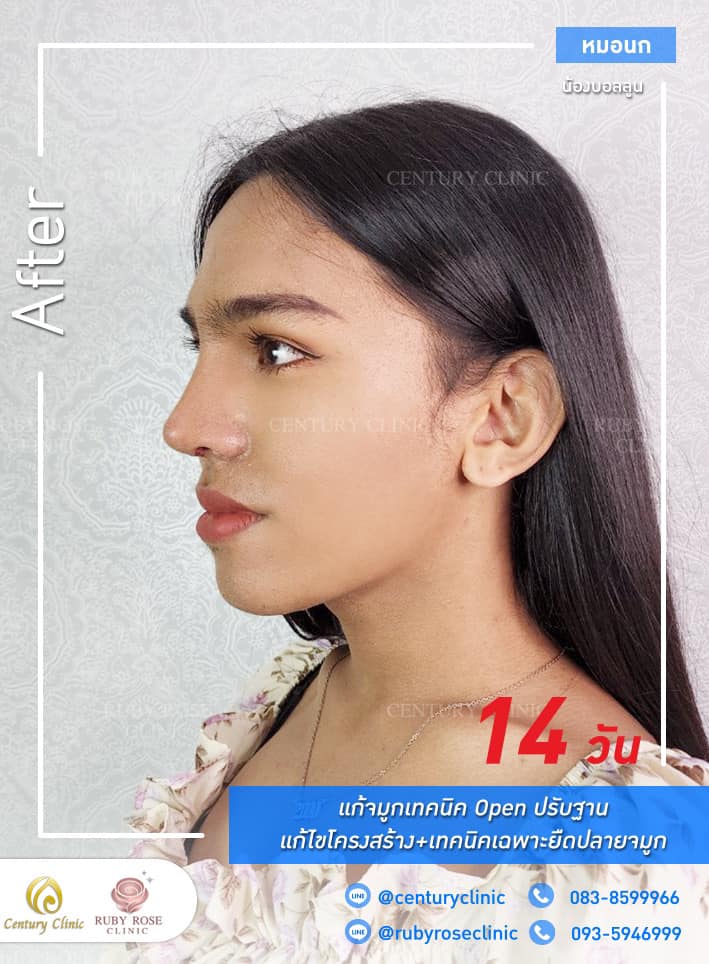 รีวิว แก้จมูก #339 , Century Clinic Thailand Century-รีวิว-แก้จมูก 1#339