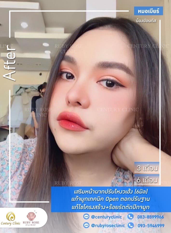 Century-รีวิว-แก้จมูก 1#342