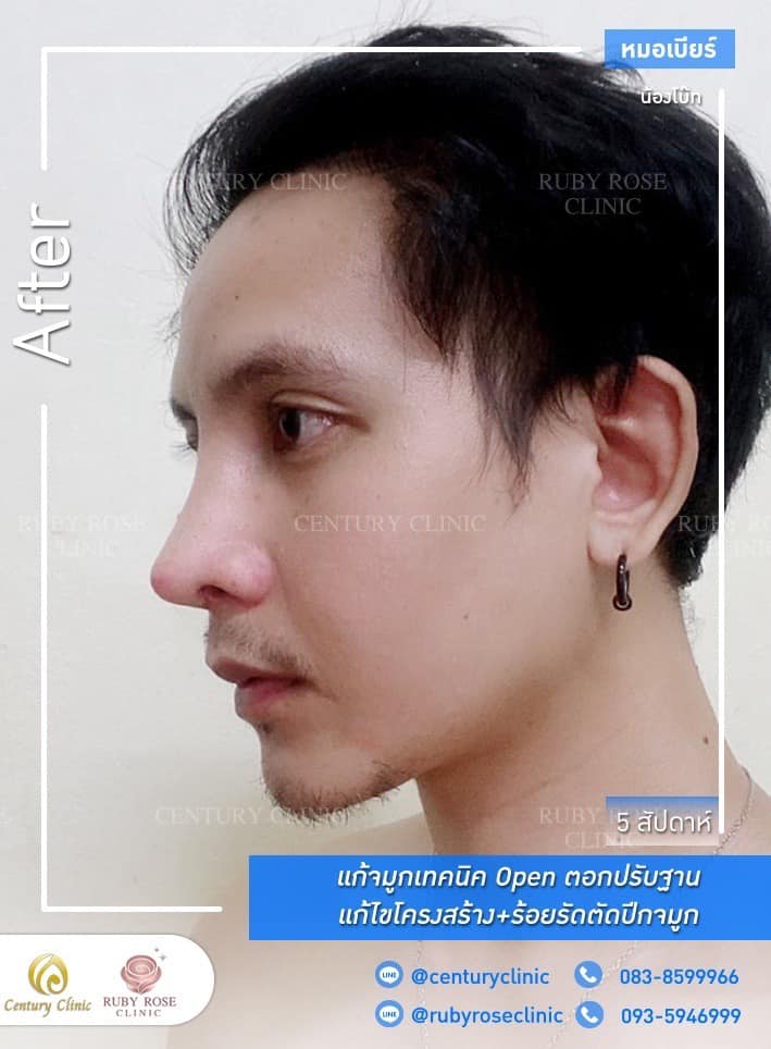 รีวิว แก้จมูก #346 , Century Clinic Thailand Century-รีวิว-แก้จมูก 1#346