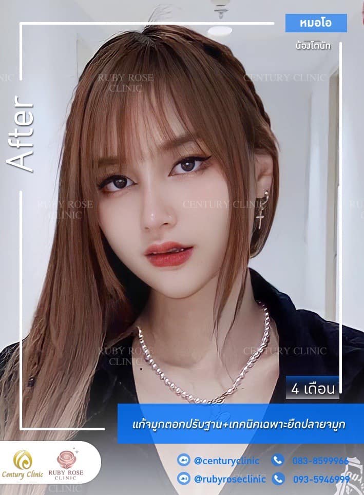 Century-รีวิว-แก้จมู 2#349