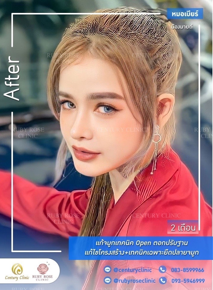 Century-รีวิว-แก้จมูก 1#351