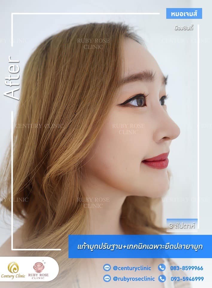 รีวิว แก้จมูก #352 , Century Clinic Thailand Century-รีวิว-แก้จมูก 1#352