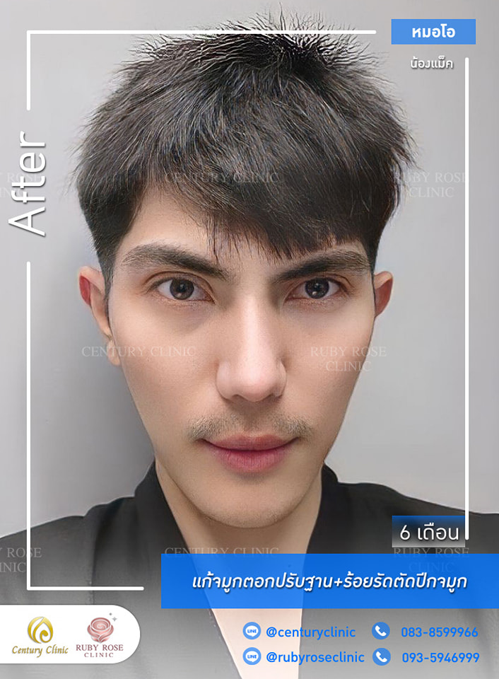 รีวิว แก้จมูก #353 , Century Clinic Thailand Century-รีวิว-แก้จมูก 1#353