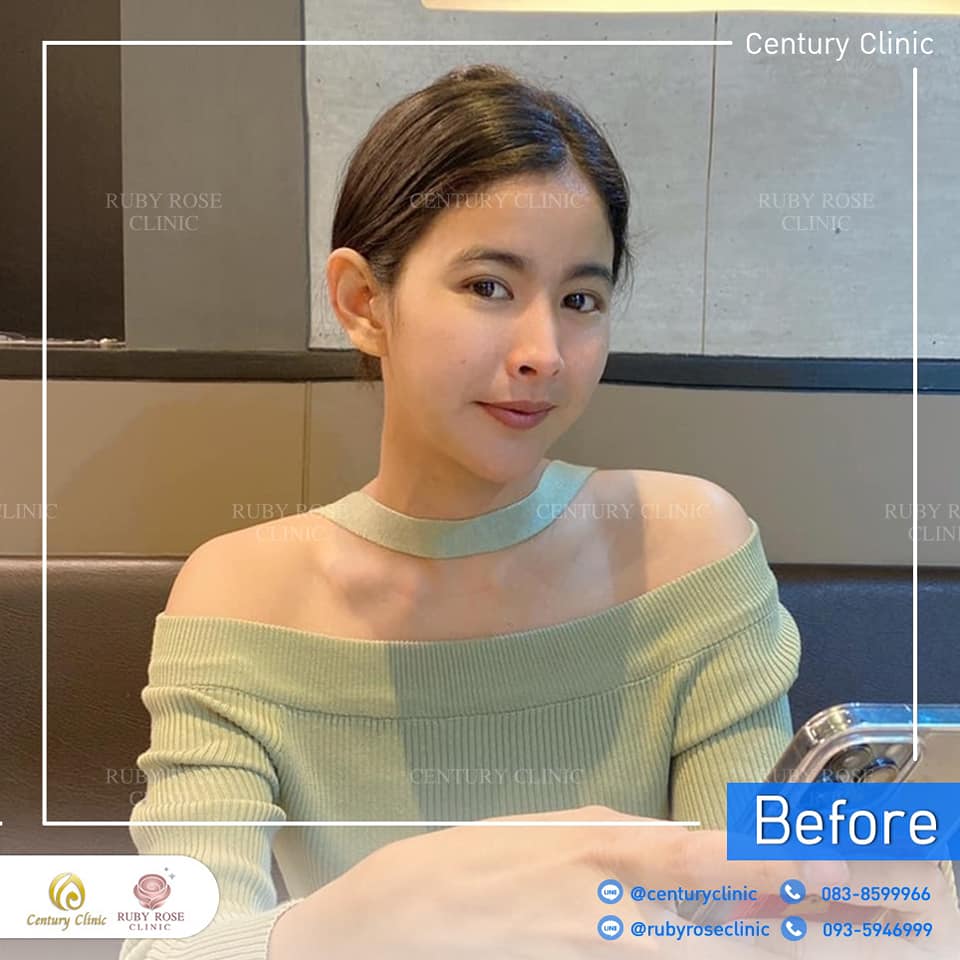 รีวิว แก้จมูก #299 , Century Clinic Thailand Century-รีวิว-แก้จมูก 2 #299