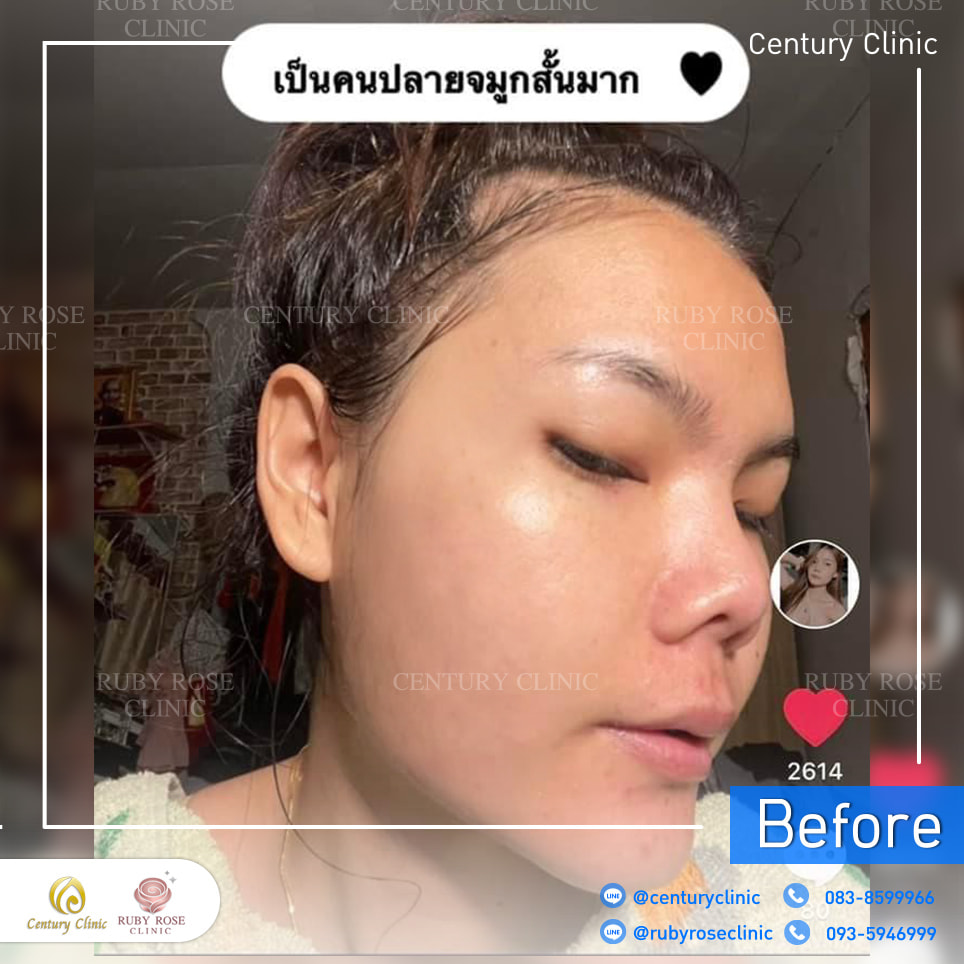 Century-รีวิว-แก้จมูก 2 #307
