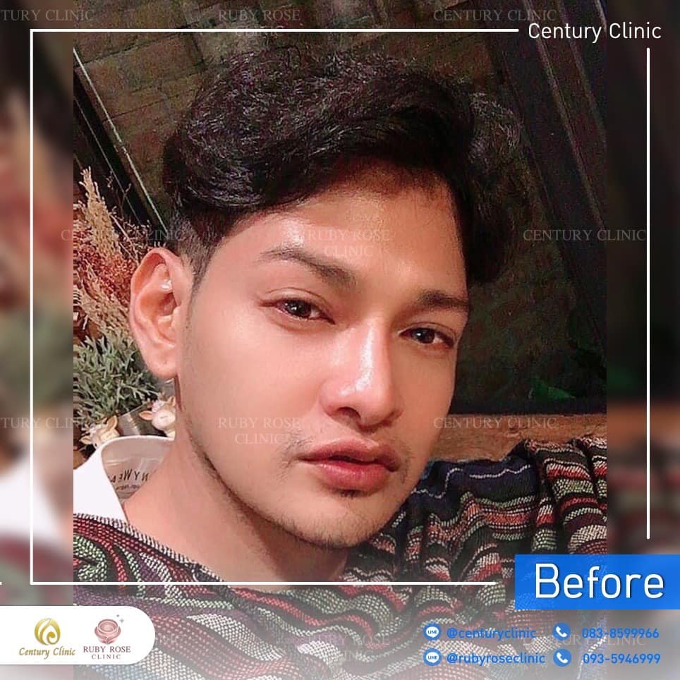 Century รีวิว แก้จมูก 2#278