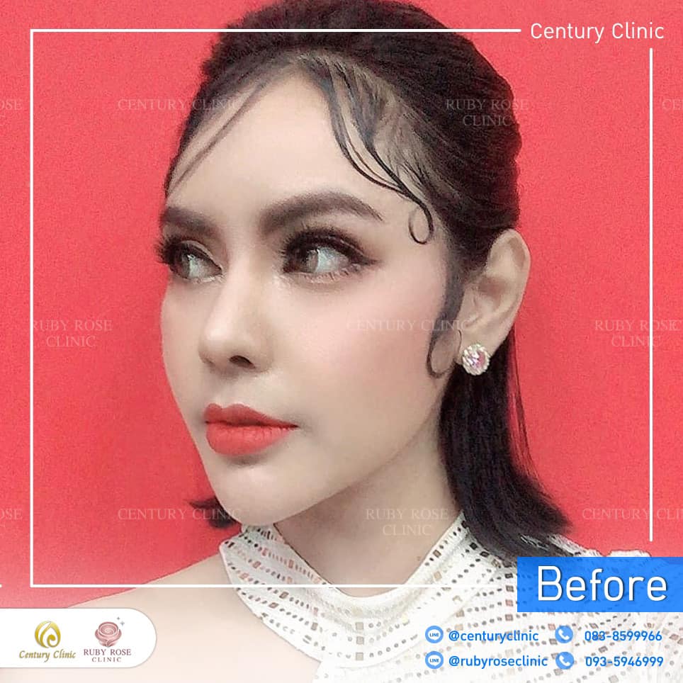 Century รีวิว แก้จมูก 2#283