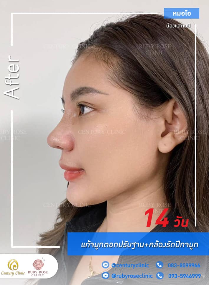 Century รีวิว แก้จมูก 2#285