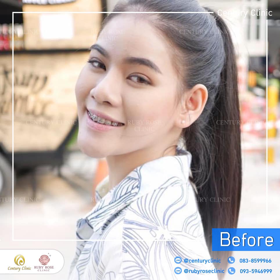 รีวิว แก้จมูก #294 , Century Clinic Thailand Century-รีวิว-แก้จมูก 2#294
