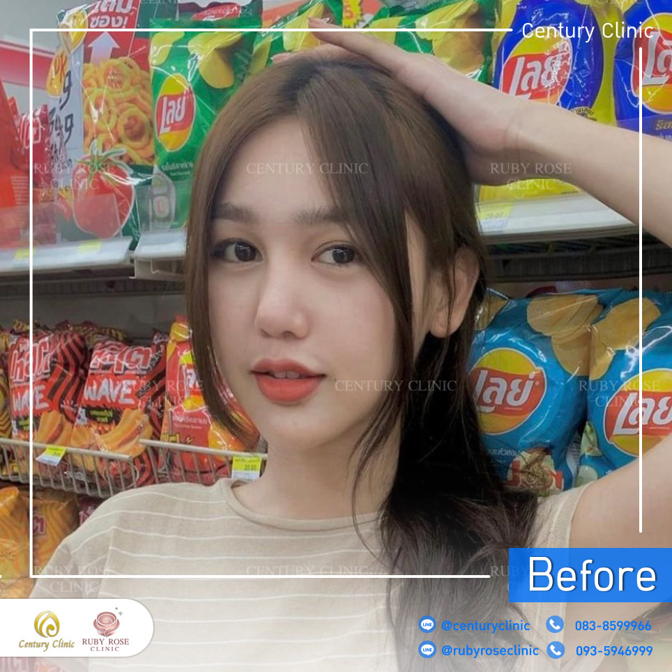 รีวิว แก้จมูก #297 , Century Clinic Thailand Century-รีวิว-แก้จมูก 2#297