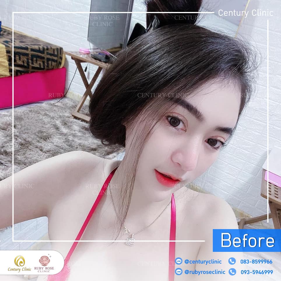 Century-รีวิว-แก้จมูก 2#304
