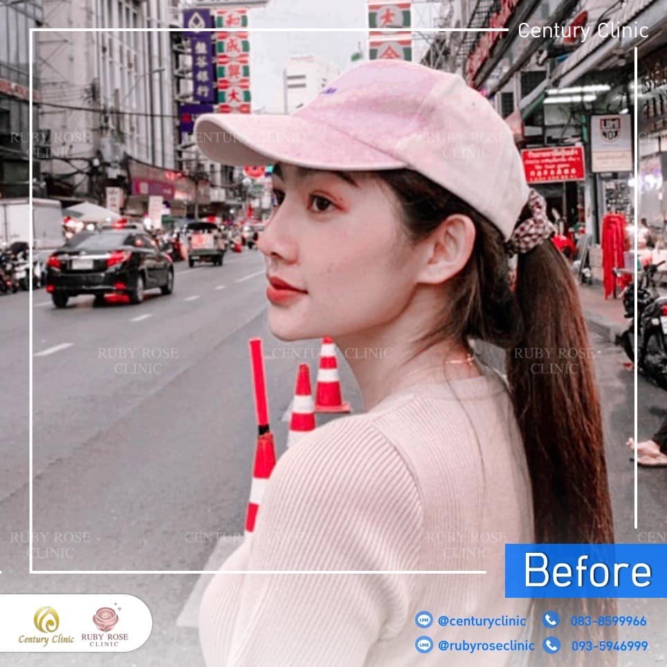 Century-รีวิว-แก้จมูก 2#308