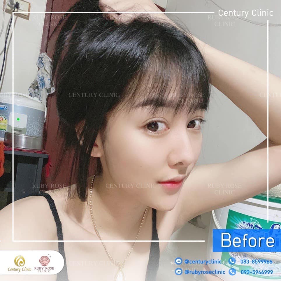 Century-รีวิว-แก้จมูก 2#309