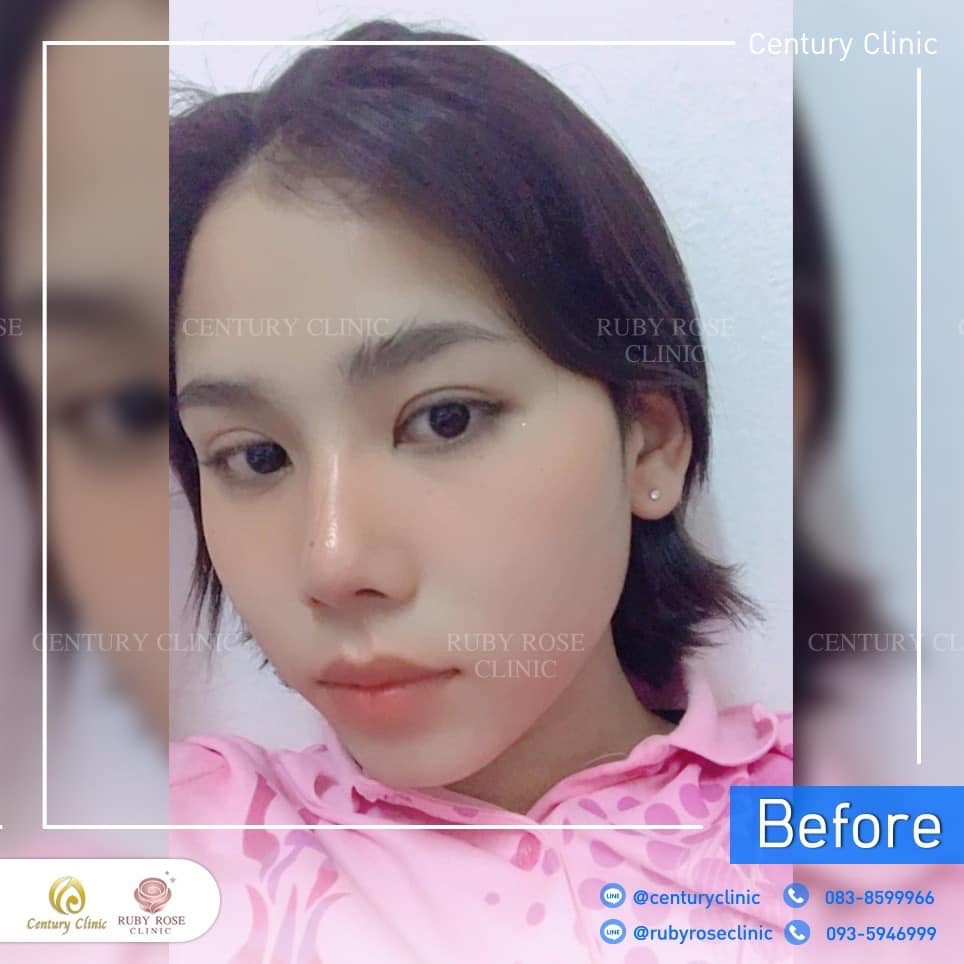 รีวิว แก้จมูก #311 , Century Clinic Thailand Century-รีวิว-แก้จมูก 2#311