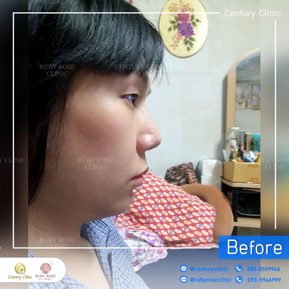 รีวิว แก้จมูก #316 , Century Clinic Thailand Century-รีวิว-แก้จมูก 2#316