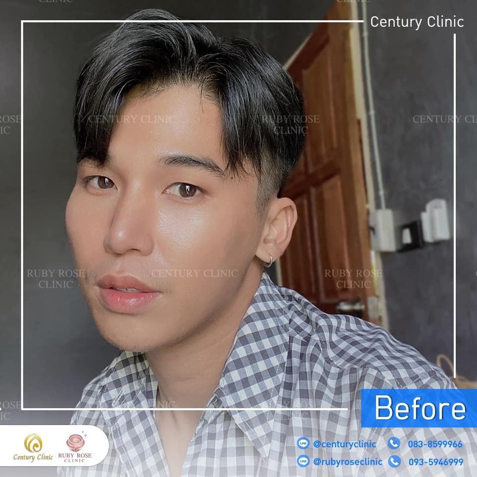 รีวิว แก้จมูก #330 , Century Clinic Thailand Century-รีวิว-แก้จมูก 2#330