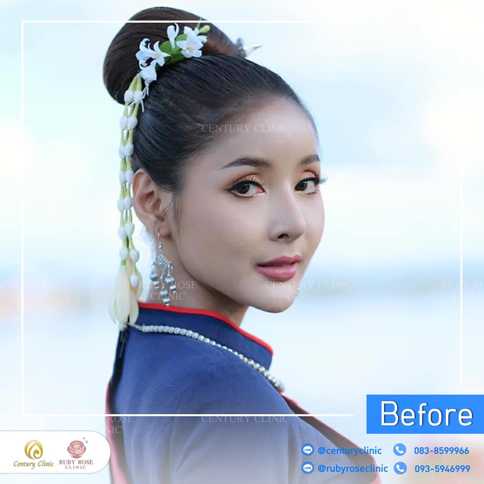 รีวิว แก้จมูก #333 , Century Clinic Thailand Century-รีวิว-แก้จมูก 2#333