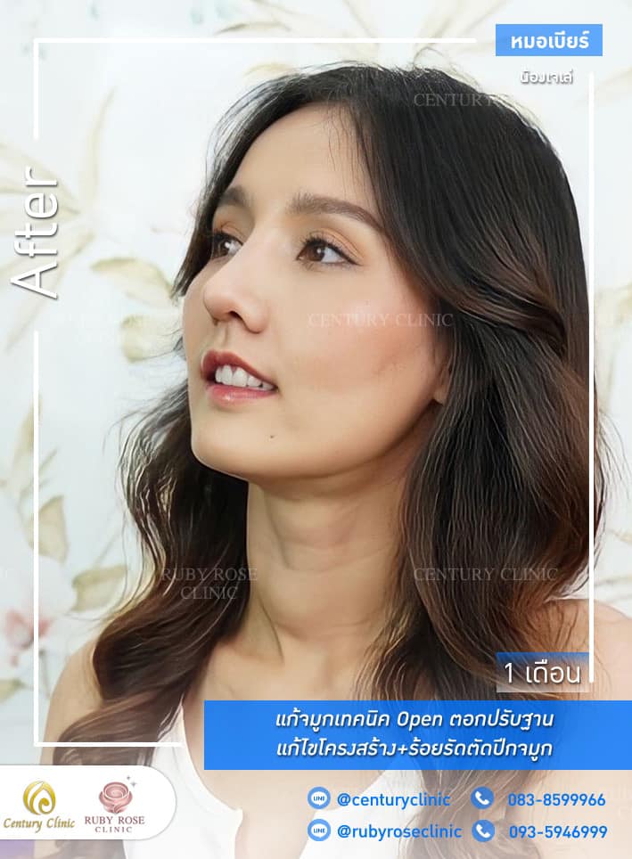รีวิว แก้จมูก #336 , Century Clinic Thailand Century-รีวิว-แก้จมูก 2#336